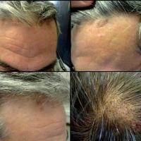 
	Alopecia mucinosa (follicular mucinosis)