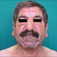 
	Scleromyxoedema

	Copied with kind…