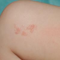 
	Localised LM in an infant (cutaneous papular…