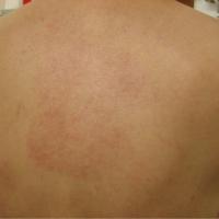 
	Reticular erythematous mucinosis