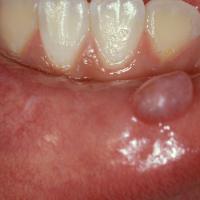 
	Mucocele