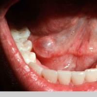 
	Mucocele on the floor of the mouth, also known…
