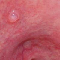 
	Superficial mucocele on the hard palate