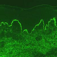 
	MMP

	Direct immunofluorescence shows linear…