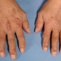 Multicentric reticulohistiocytosis
Copied with…
