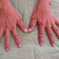 Multicentric reticulohistiocytosis