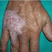 
	Lupus vulgaris 
