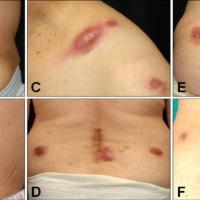 
	Primary tuberculosis following…