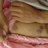 
	Tuberculous gumma