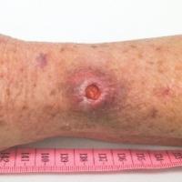 
	Mycobacterium ulcerans