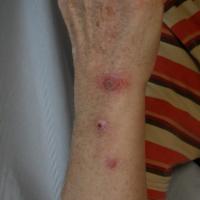 
	Mycobacteria marinum

	Several lesions from the…