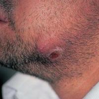 
	Scrofuloderma
