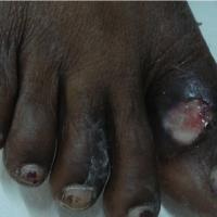 
	Scrofuloderma