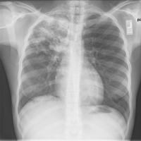
	Pulmonary tuberculosis

	Multifocal patchy…