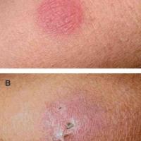
	Cutaneous tuberculosis

	Two lesions in the…