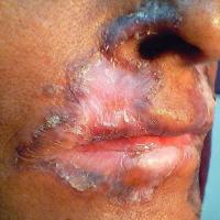 
	Lupus vulgaris