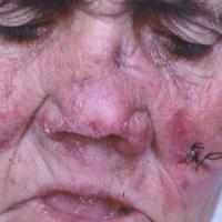 
	Lupus vulgaris

	Copied with kind permission…