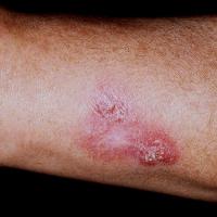 
	Lupus vulgaris

	Copied with kind permission…