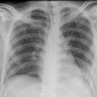 
	CXR of miliary tuberculosis