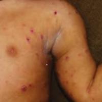 
	Miliary tuberculosis 
