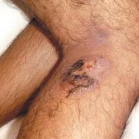 
	Tuberculous gumma