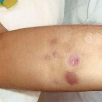 
	Tuberculous gumma