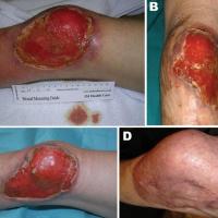 
	Mycobacterium ulcerans

	Progression of Buruli…