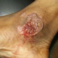 
	Tuberculous chancre