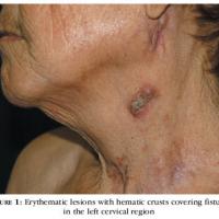 
	Scrofuloderma