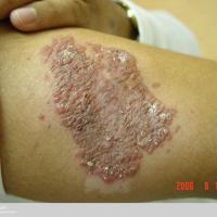 
	Warty tuberculosis