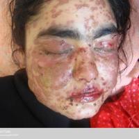 Stevens-Johnson syndrome&nbsp;can be associated…