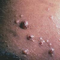 
	Cryptococcal infection&nbsp;