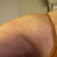 
	Same patient as previous image

	This had a…