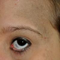 Naevus of Ota affecting the eyeCopied with kind…