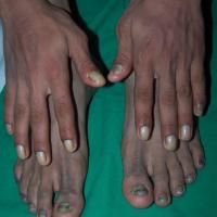 
	Yellow Nail syndrome