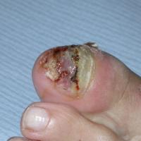 
	Subungual melanoma showing nail destruction