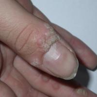 
	Common wart