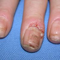 
	Eczema and transverse ridges