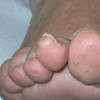 
	Acquired fibrous nodule
