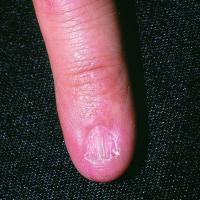 
	Lichen planus: late-stage nail disease with…