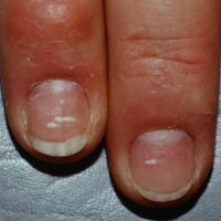 
	Partial leukonychia secondary to trauma 