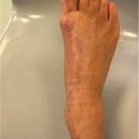 
	Linear lichen planus
