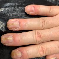 Habit-tic nail deformity - same patient as…