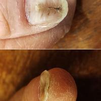Median nail dystrophy