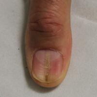 
	Median nail dystrophy