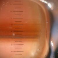 
	Melanoma

	Dermoscopy of the nail plate…