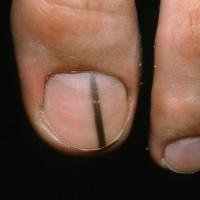 
	Subungual melanoma (in situ)