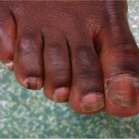 
	Longitudinal melanonychia in a darker-skinned…