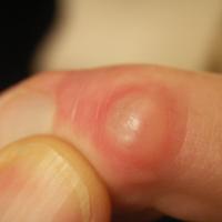 
	Myxoid cyst