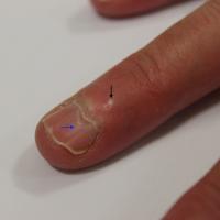 
	A myxoid cyst (black arrow) affecting nail…
